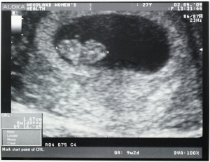 human embryo at 8 weeks